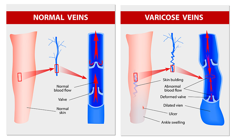 Endovenous laser treatment for veins Endovenous laser treatment for veins