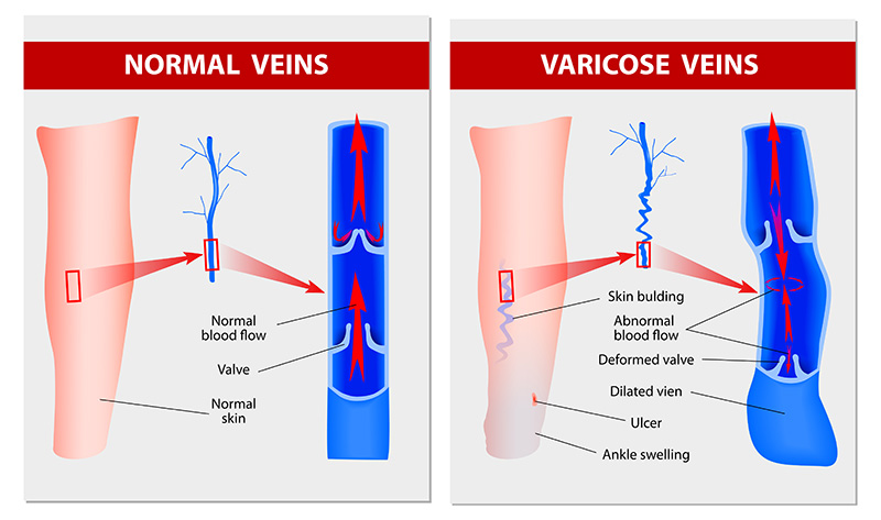 Endovenous laser treatment for veins